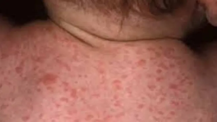 New York Declares Statewide Emergency as Measles Cases Reach 108