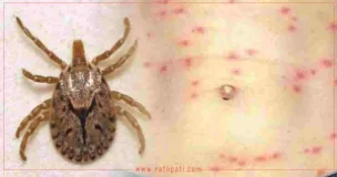 Scrub Typhus Cases Top 10,000 Across 74 Districts in Nepal